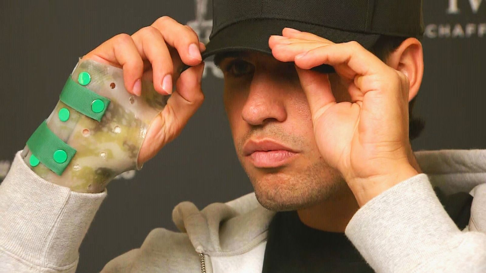 Alcaraz lesione rivelata polso